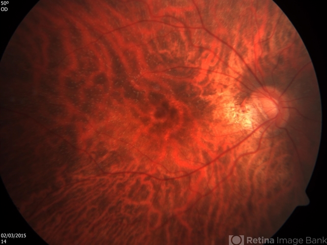 Fundus albipunctatus (FA): a night blindness cause