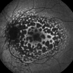 Leopard Chorioretinopathy