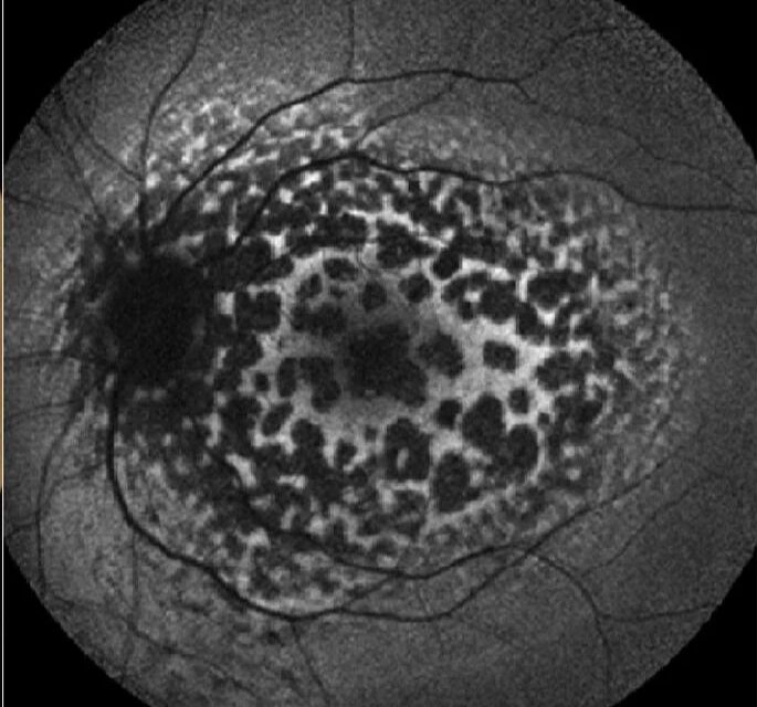 Leopard Chorioretinopathy: case study, diagnosis and management