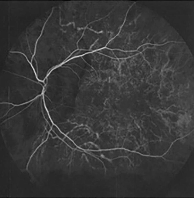 Leopard Chorioretinopathy