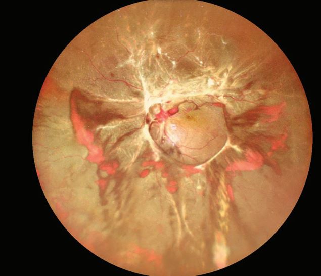 Crunch Syndrome: sight threating lesion