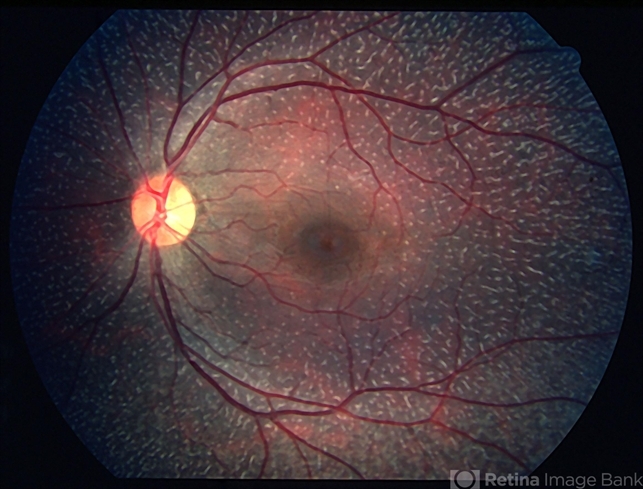 Fundus albipunctatus