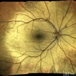 Oguchi disease