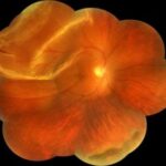 Macula-on Rhegmatogenous Retinal Detachment