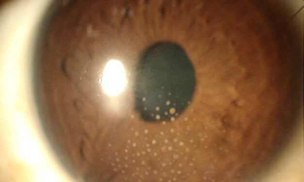 Arlt’s Triangle: management strategies - Ophthalmology Education