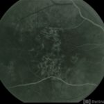 Central Areolar Choroidal Dystrophy (CACD)