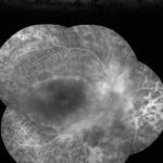 Goldmann-Favre syndrome