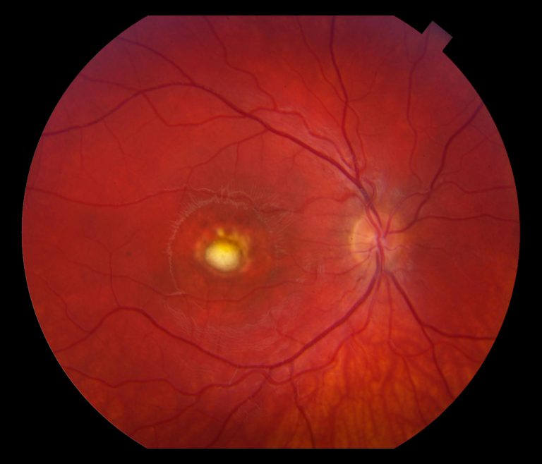 Vitelliform macular dystrophy
