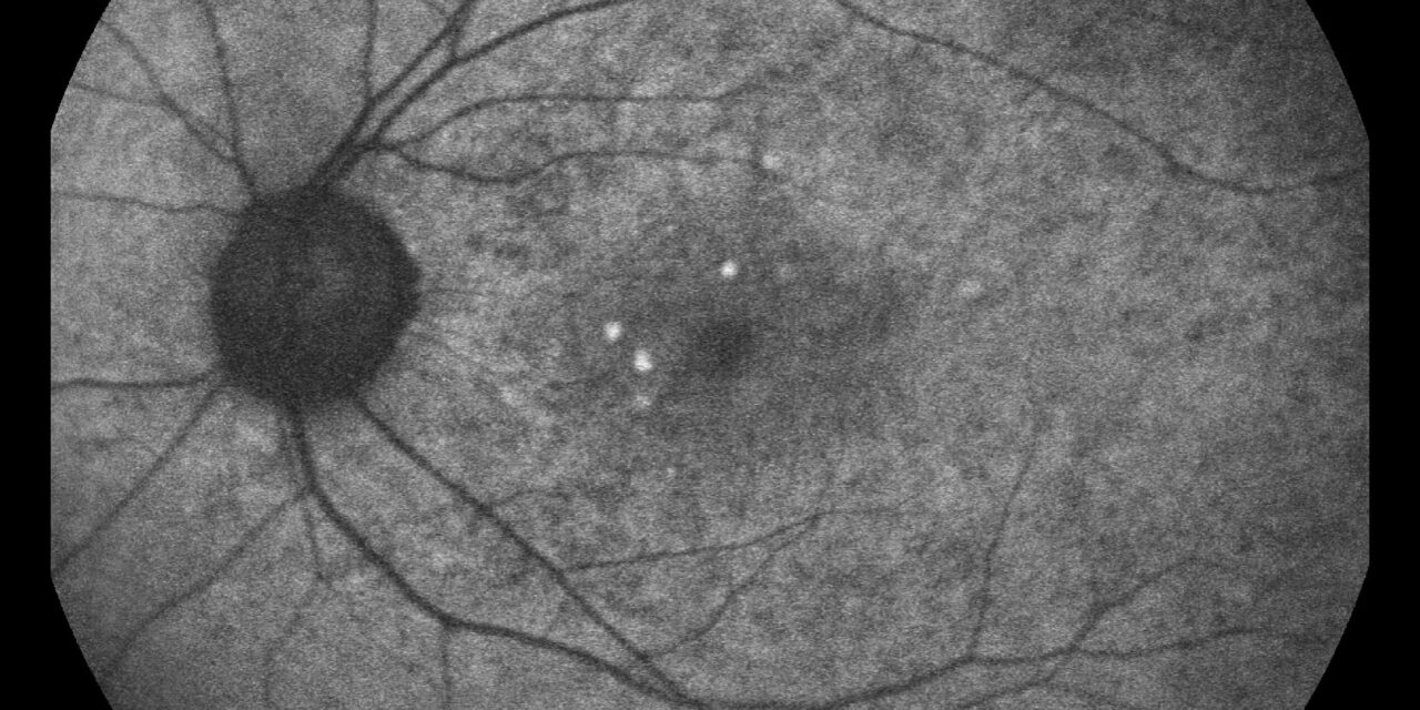 Reticular pseudodrusen: updates for ophthalmologists