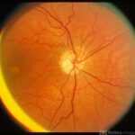 Vitelliform macular dystrophy