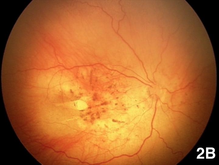 Zika virus retinopathy