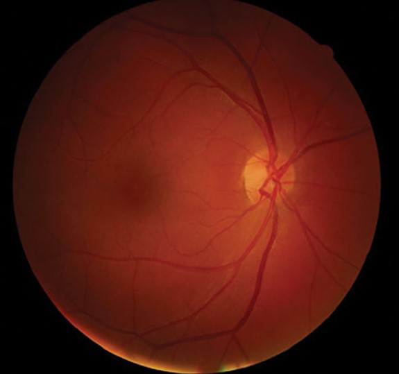 Poppers Maculopathy
