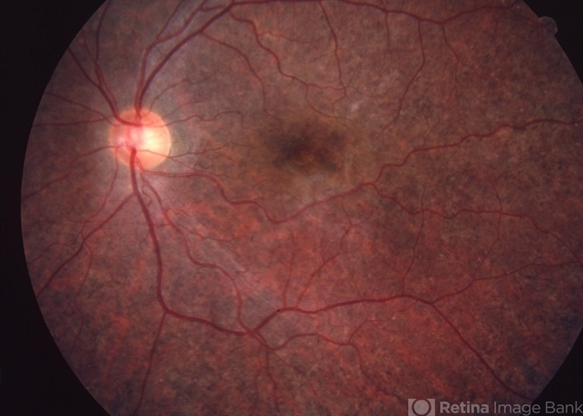 Kearns-Sayre Ptosis