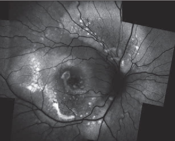 Multifocal Vitelliform Dystrophy