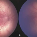 Zika virus retinopathy
