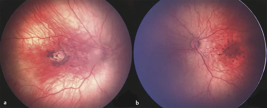Zika virus retinopathy