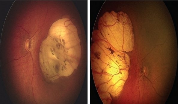Zika virus retinopathy