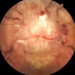 Bartonella Henselae Neuroretinitis