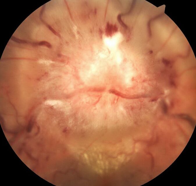 Bartonella Henselae Neuroretinitis
