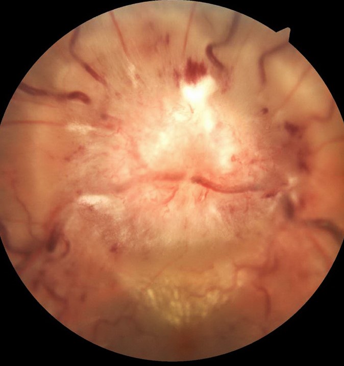 Bartonella Henselae Neuroretinitis