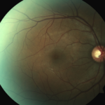Poppers Maculopathy