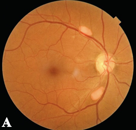 Multifocal Vitelliform Dystrophy - Ophthalmology Education