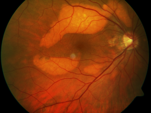 Multifocal Vitelliform Dystrophy