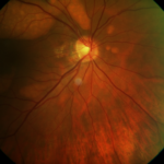 Multifocal Vitelliform Dystrophy
