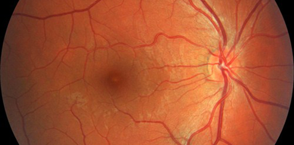 Poppers Maculopathy