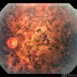 Retinitis Pigmentosa