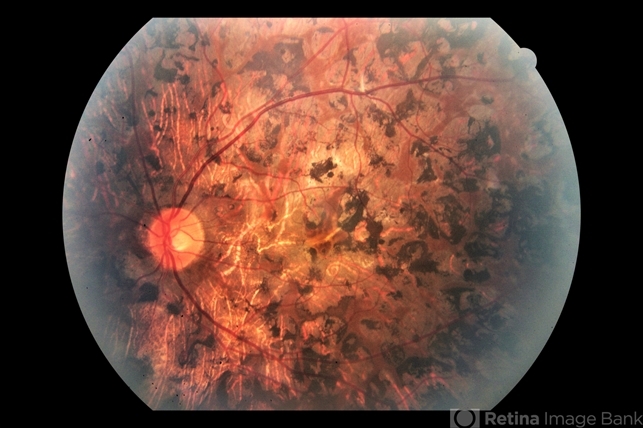 Not Just Retinitis Pigmentosa: Other Causes of Night Vision Loss