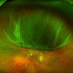 Retinal detachment