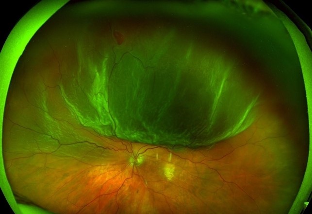 Retinal Detachment Lookalikes: What Else Should You Consider?