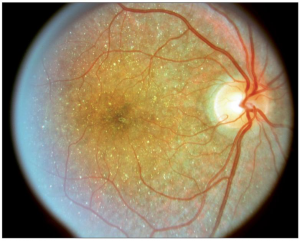 Bietti Crystalline Dystrophy
