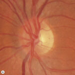 Optic Disc Swelling