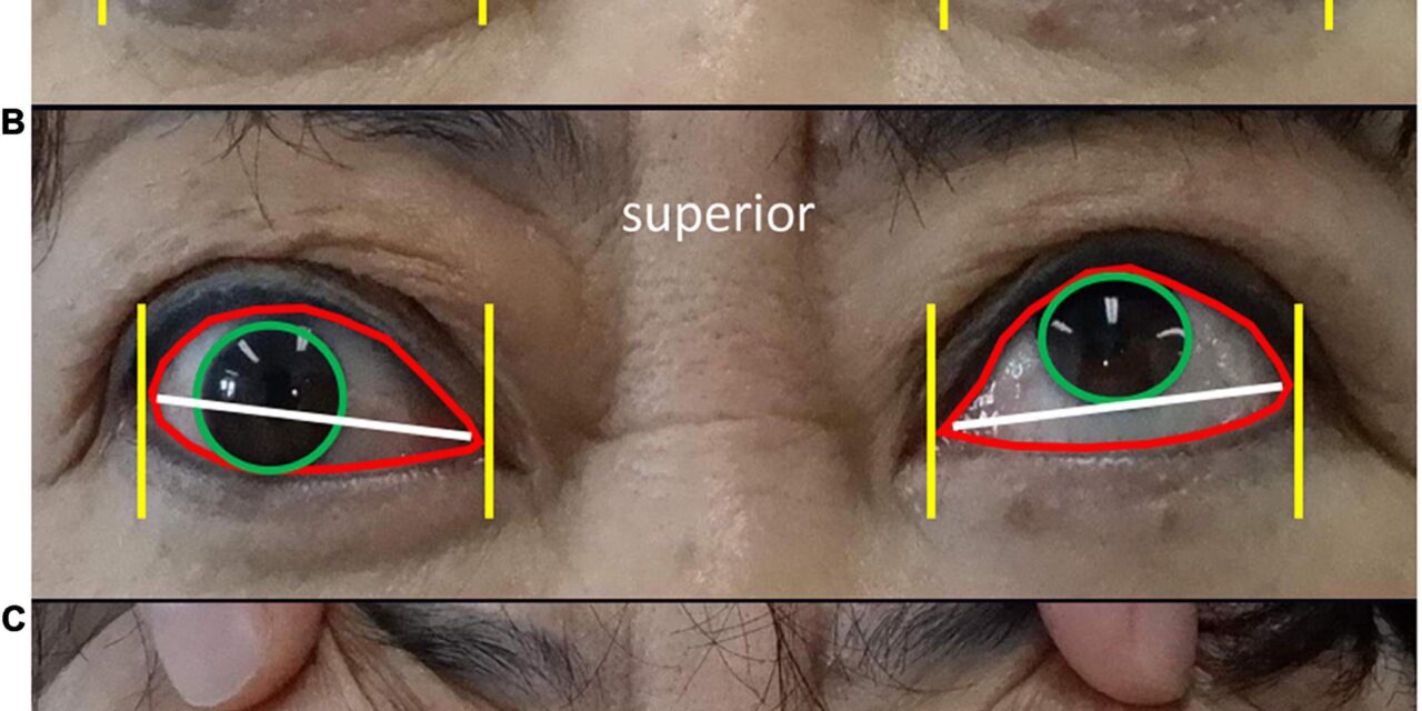 AI advances in thyroid-associated ophthalmopathy: A new paper