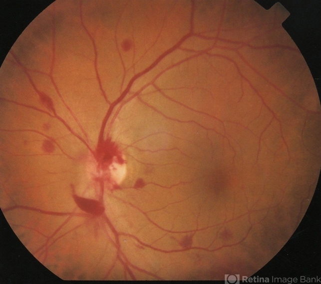 Central Serous Chorioretinopathy