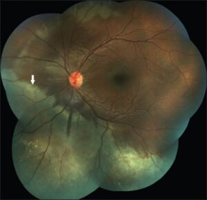 Macular Roth Spot Beyond Cherry-Red Spot: What Else Causes Macular Redness ...