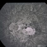 myopia