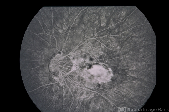 Cone Changes After Red Light Therapy in Myopic Children