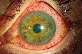 Acute Anterior Uveitis