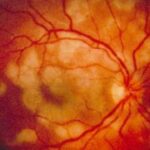 White Dot Syndrome