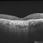 Outer Retinal Tubulation