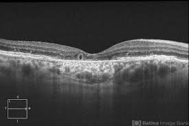 Outer Retinal Tubulation: Marker or Misdiagnosis?