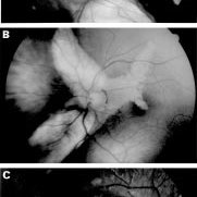 Helicoid Peripapillary Chorioretinal Degeneration