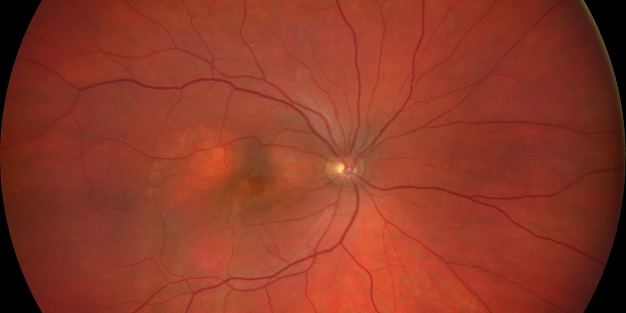 Pachychoroid Neovasculopathy: A Deep Dive into a Choroidal Disease