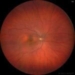 Pachychoroid Neovasculopathy