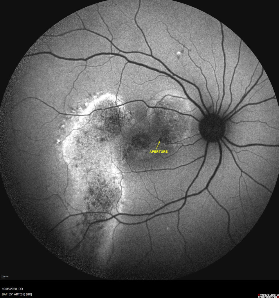 Pachychoroid Neovasculopathy