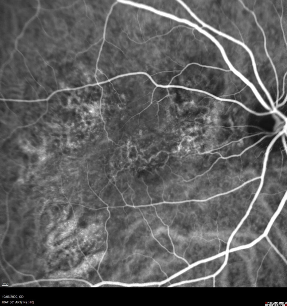 Pachychoroid Neovasculopathy