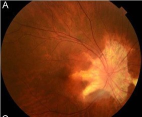 Helicoid Peripapillary Chorioretinal Degeneration